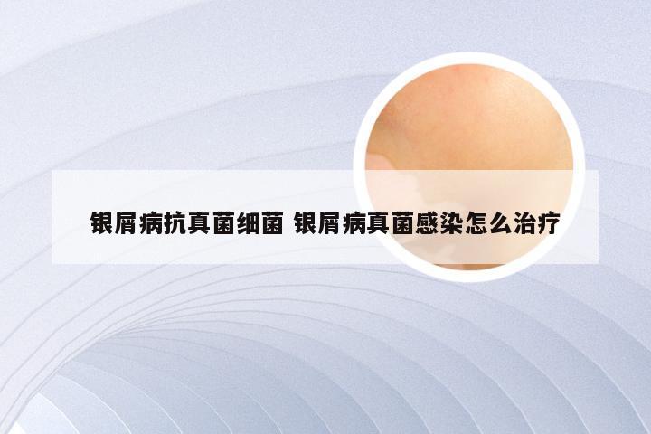 银屑病抗真菌细菌 银屑病真菌感染怎么治疗