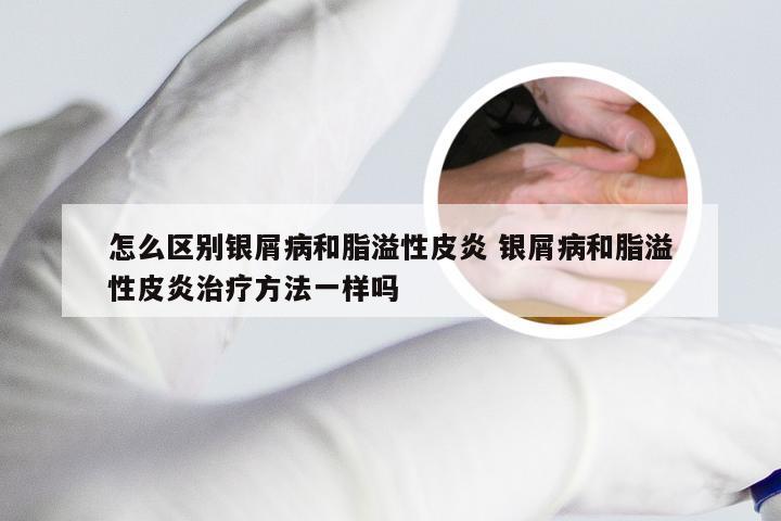 怎么区别银屑病和脂溢性皮炎 银屑病和脂溢性皮炎治疗方法一样吗