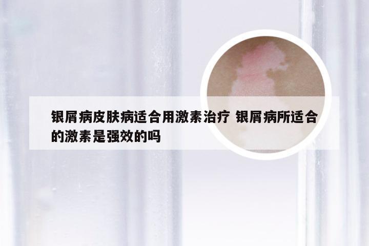 银屑病皮肤病适合用激素治疗 银屑病所适合的激素是强效的吗
