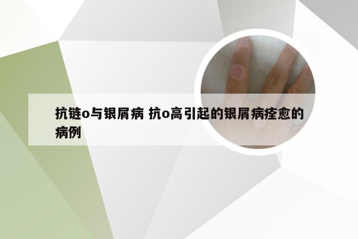 抗链o与银屑病 抗o高引起的银屑病痊愈的病例