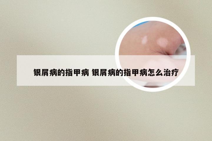 银屑病的指甲病 银屑病的指甲病怎么治疗