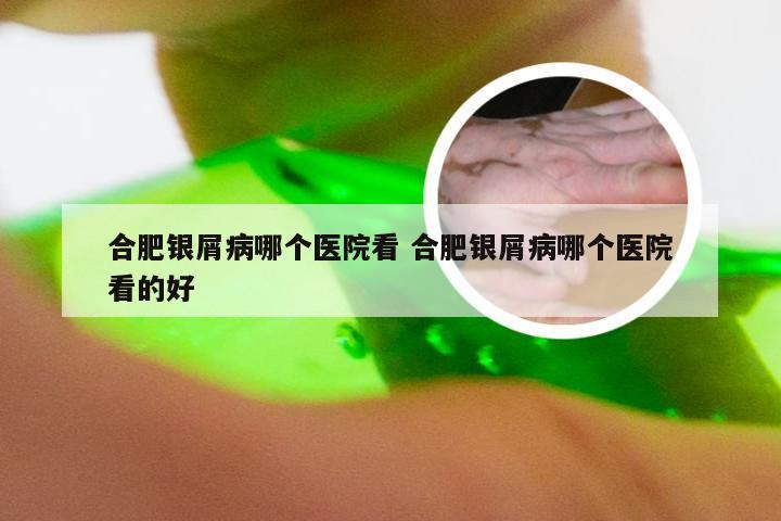 合肥银屑病哪个医院看 合肥银屑病哪个医院看的好
