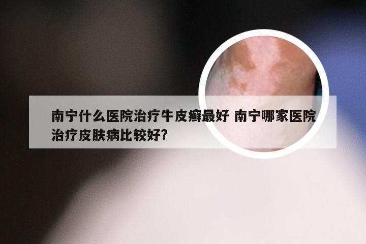 南宁什么医院治疗牛皮癣最好 南宁哪家医院治疗皮肤病比较好?