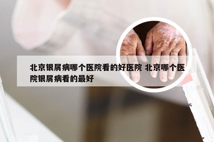 北京银屑病哪个医院看的好医院 北京哪个医院银屑病看的最好