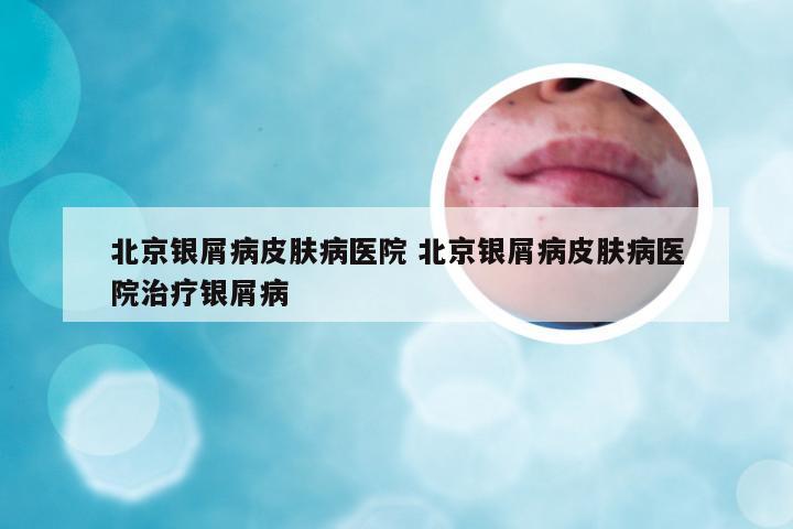 北京银屑病皮肤病医院 北京银屑病皮肤病医院治疗银屑病