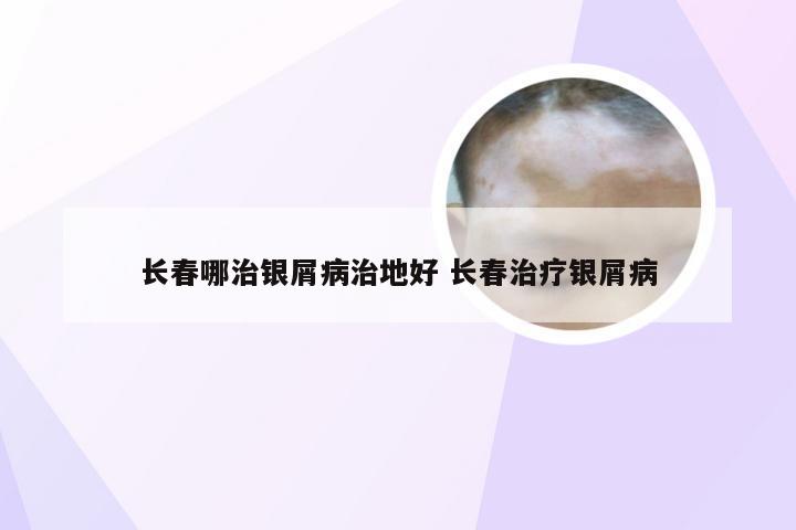 长春哪治银屑病治地好 长春治疗银屑病