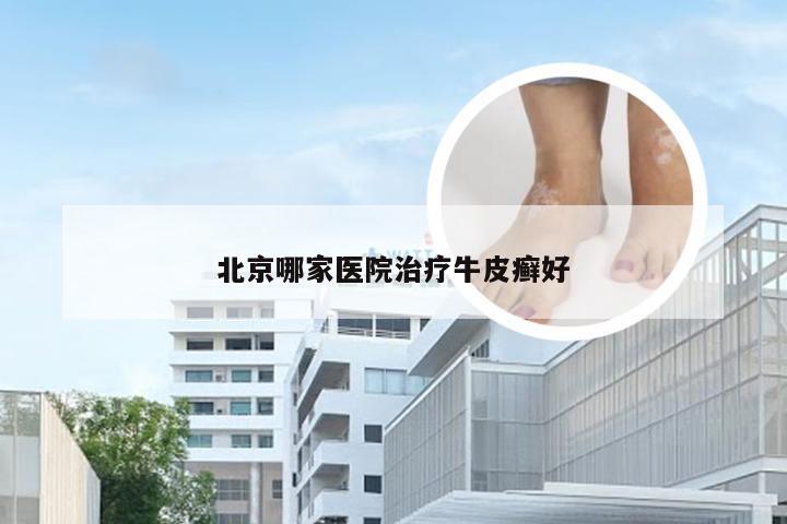 北京哪家医院治疗牛皮癣好