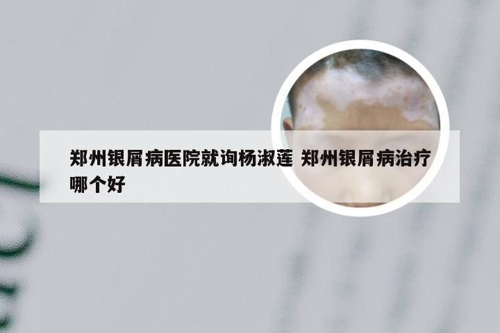 郑州银屑病医院就询杨淑莲 郑州银屑病治疗哪个好