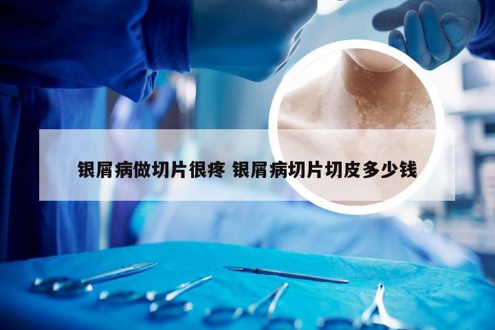 银屑病做切片很疼 银屑病切片切皮多少钱