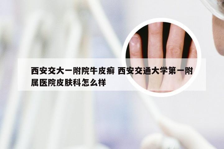 西安交大一附院牛皮癣 西安交通大学第一附属医院皮肤科怎么样
