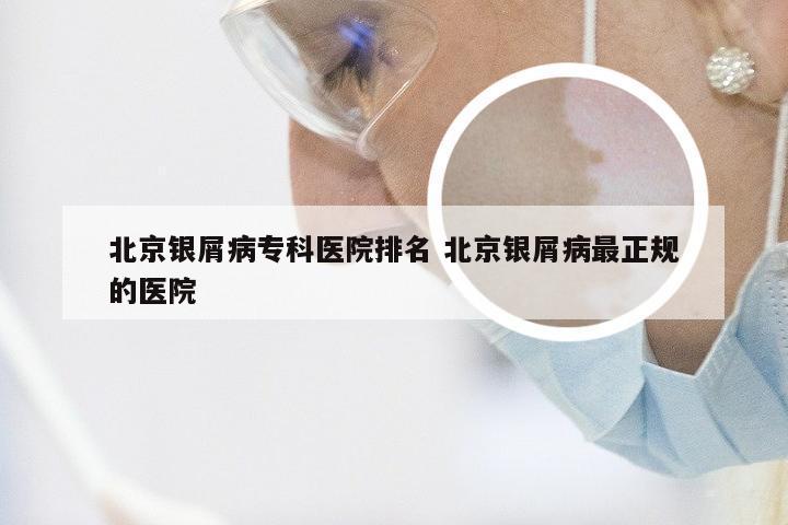 北京银屑病专科医院排名 北京银屑病最正规的医院