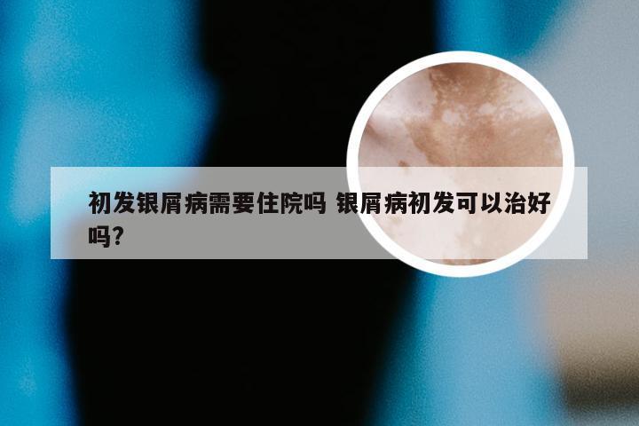 初发银屑病需要住院吗 银屑病初发可以治好吗?