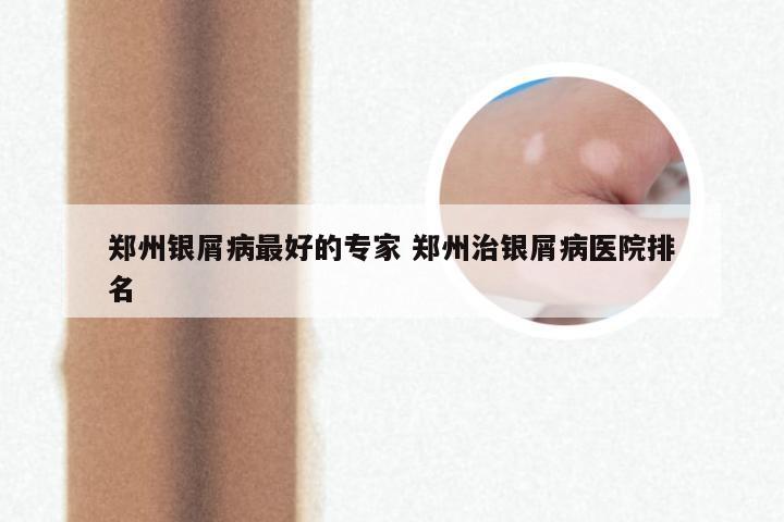 郑州银屑病最好的专家 郑州治银屑病医院排名