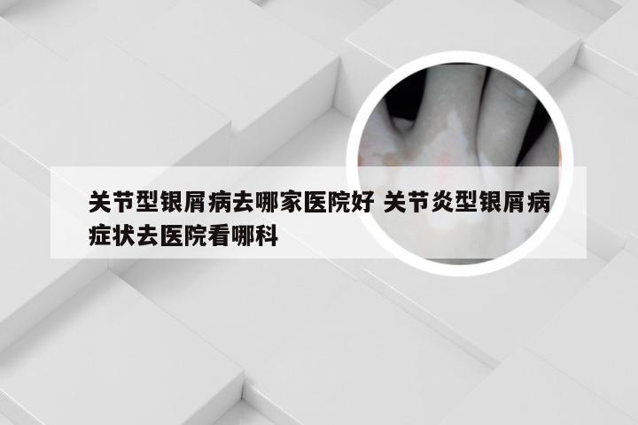 关节型银屑病去哪家医院好 关节炎型银屑病症状去医院看哪科