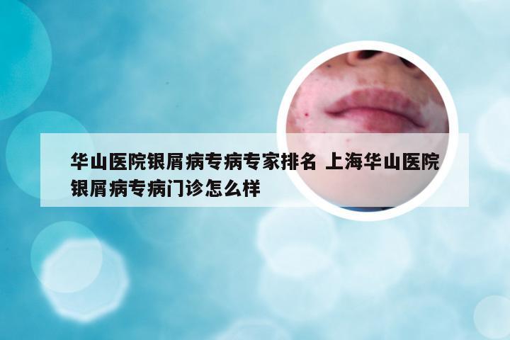 华山医院银屑病专病专家排名 上海华山医院银屑病专病门诊怎么样