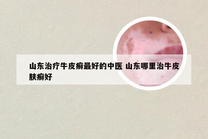 山东治疗牛皮癣最好的中医 山东哪里治牛皮肤癣好