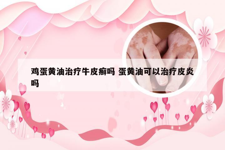 鸡蛋黄油治疗牛皮癣吗 蛋黄油可以治疗皮炎吗