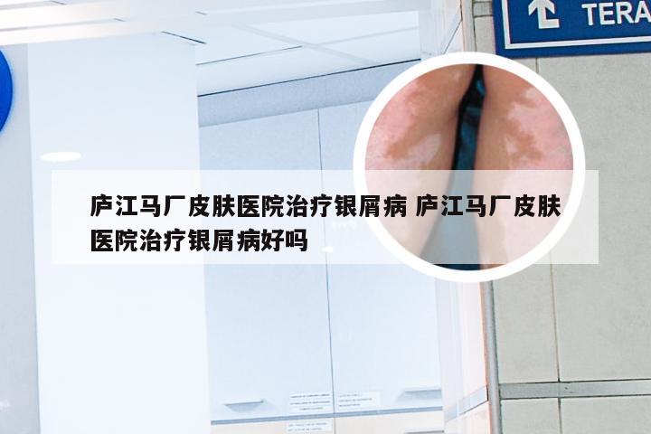 庐江马厂皮肤医院治疗银屑病 庐江马厂皮肤医院治疗银屑病好吗