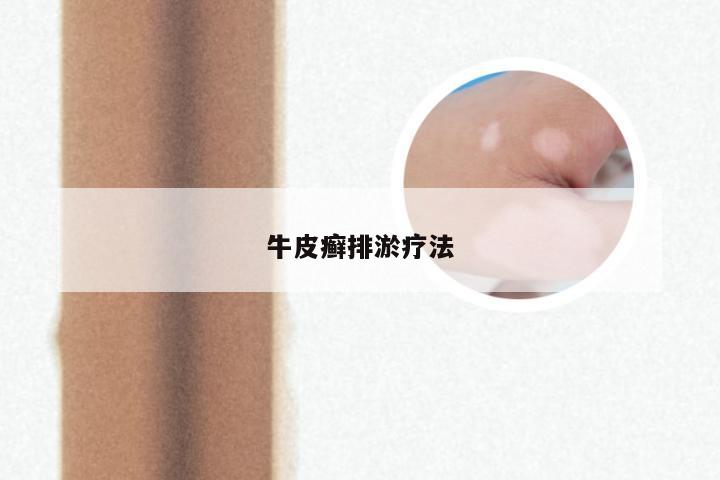 牛皮癣排淤疗法
