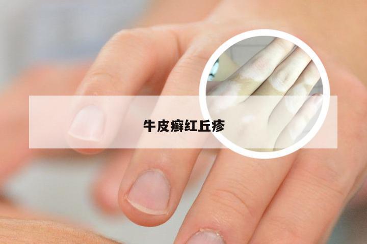牛皮癣红丘疹