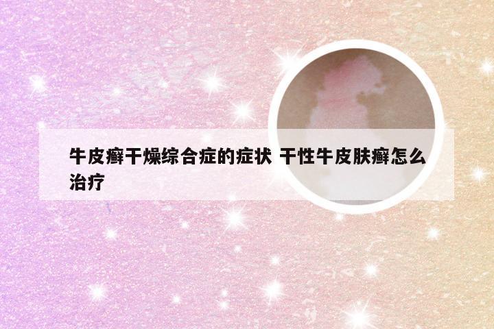牛皮癣干燥综合症的症状 干性牛皮肤癣怎么治疗