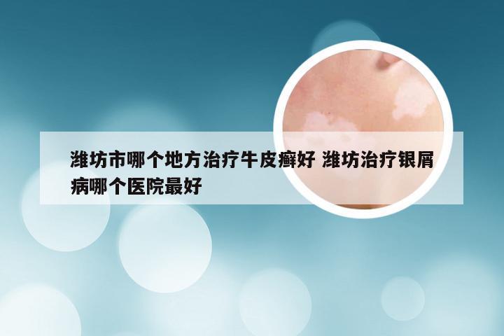 潍坊市哪个地方治疗牛皮癣好 潍坊治疗银屑病哪个医院最好