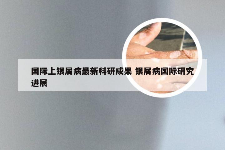 国际上银屑病最新科研成果 银屑病国际研究进展