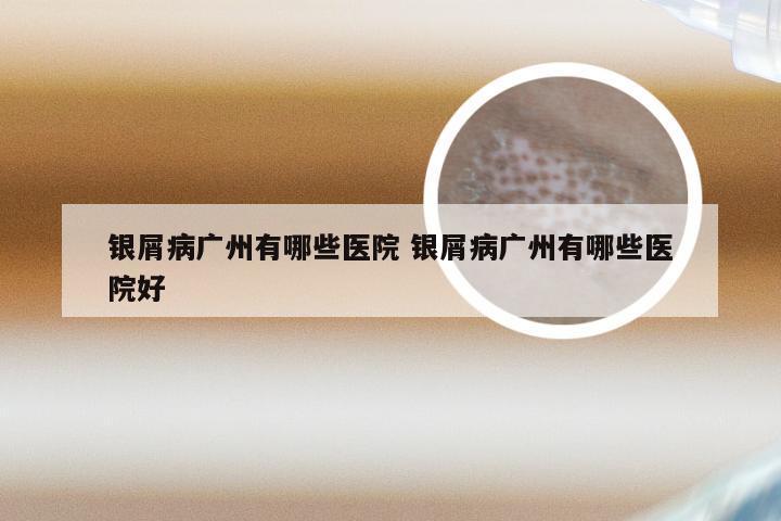 银屑病广州有哪些医院 银屑病广州有哪些医院好