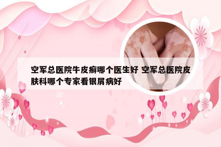 空军总医院牛皮癣哪个医生好 空军总医院皮肤科哪个专家看银屑病好