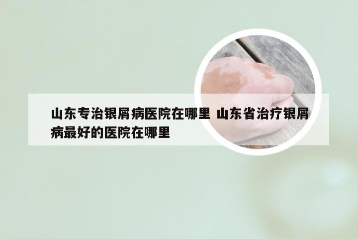山东专治银屑病医院在哪里 山东省治疗银屑病最好的医院在哪里
