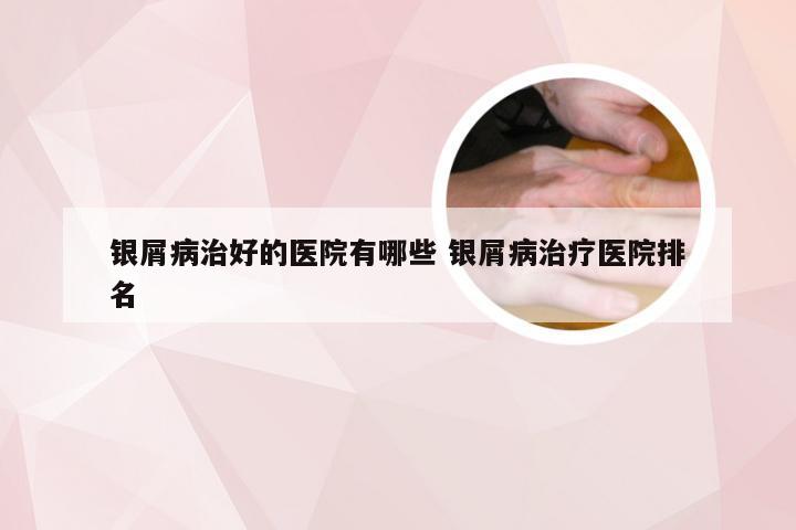 银屑病治好的医院有哪些 银屑病治疗医院排名