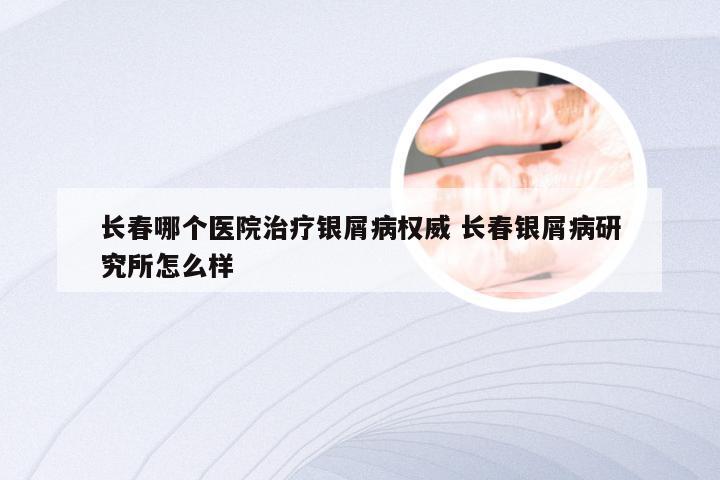 长春哪个医院治疗银屑病权威 长春银屑病研究所怎么样