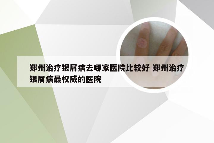 郑州治疗银屑病去哪家医院比较好 郑州治疗银屑病最权威的医院