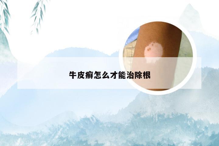 牛皮癣怎么才能治除根