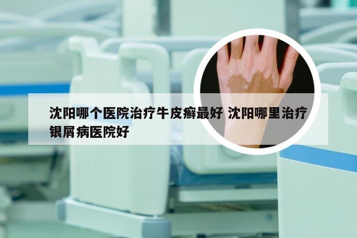 沈阳哪个医院治疗牛皮癣最好 沈阳哪里治疗银屑病医院好
