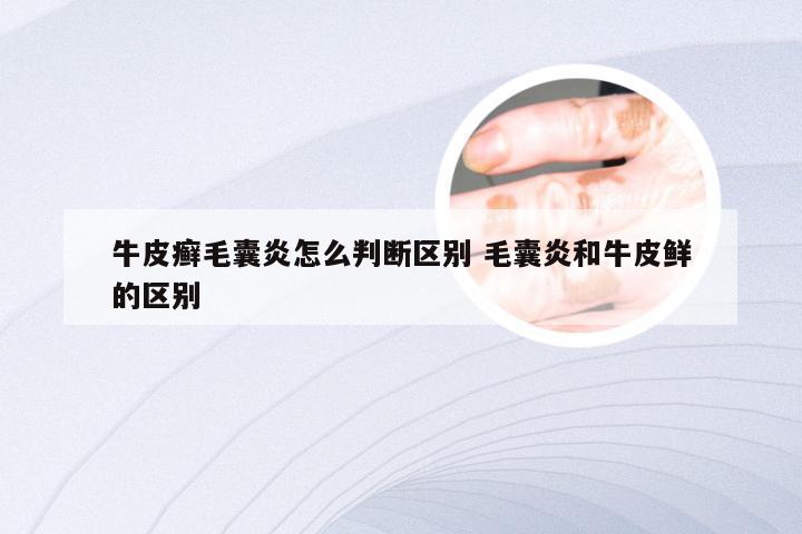 牛皮癣毛囊炎怎么判断区别 毛囊炎和牛皮鲜的区别