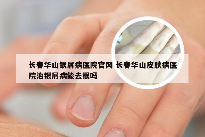 长春华山银屑病医院官网 长春华山皮肤病医院治银屑病能去根吗