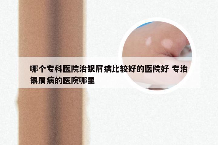 哪个专科医院治银屑病比较好的医院好 专治银屑病的医院哪里