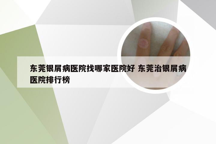 东莞银屑病医院找哪家医院好 东莞治银屑病医院排行榜