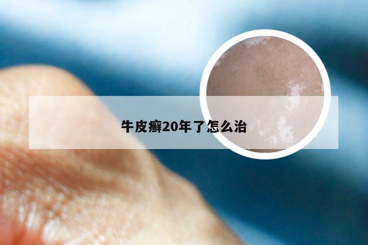 牛皮癣20年了怎么治