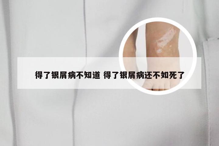 得了银屑病不知道 得了银屑病还不如死了