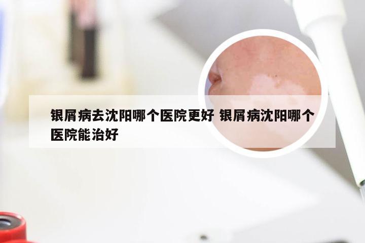 银屑病去沈阳哪个医院更好 银屑病沈阳哪个医院能治好