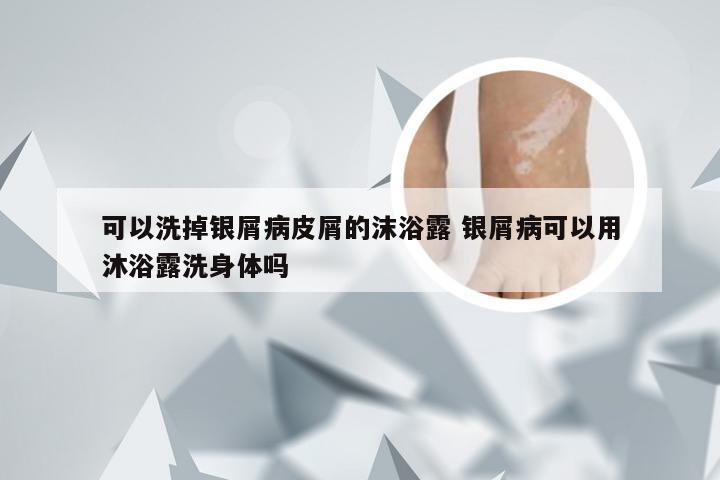 可以洗掉银屑病皮屑的沫浴露 银屑病可以用沐浴露洗身体吗