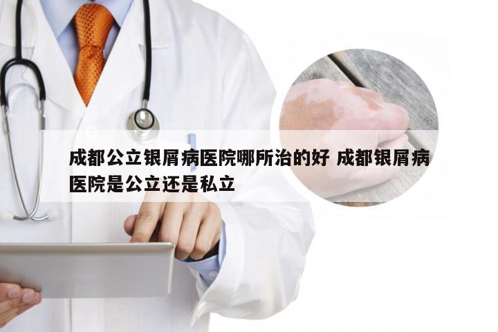 成都公立银屑病医院哪所治的好 成都银屑病医院是公立还是私立