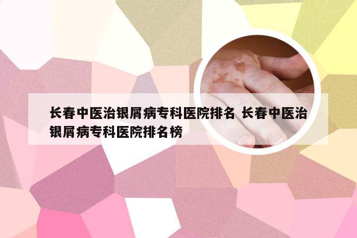 长春中医治银屑病专科医院排名 长春中医治银屑病专科医院排名榜