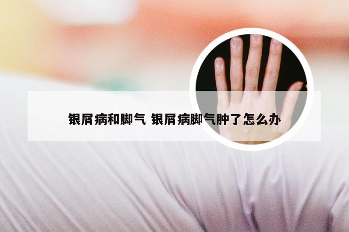银屑病和脚气 银屑病脚气肿了怎么办