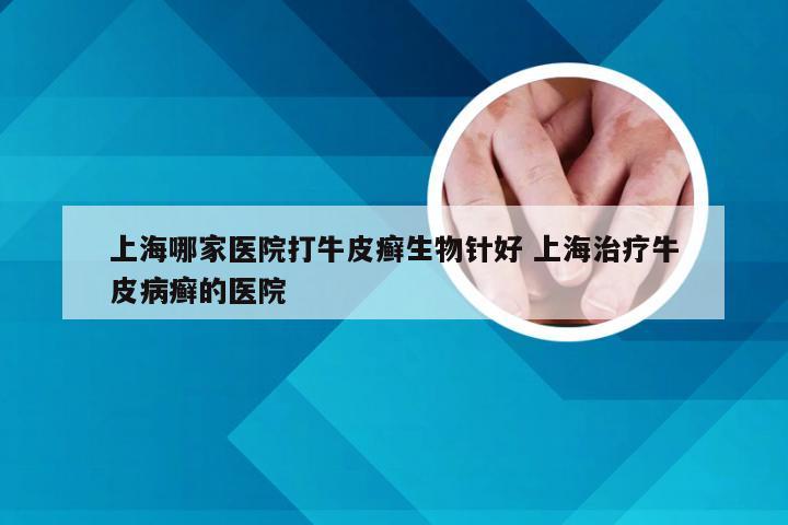 上海哪家医院打牛皮癣生物针好 上海治疗牛皮病癣的医院