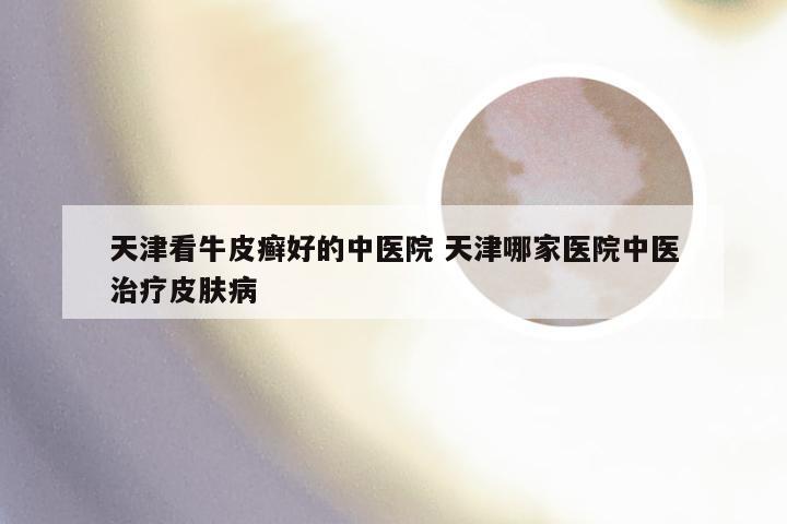 天津看牛皮癣好的中医院 天津哪家医院中医治疗皮肤病