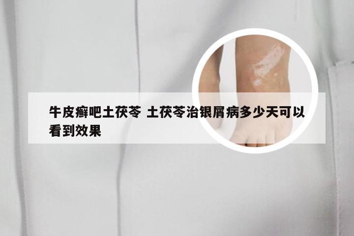 牛皮癣吧土茯苓 土茯苓治银屑病多少天可以看到效果