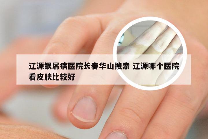 辽源银屑病医院长春华山搜索 辽源哪个医院看皮肤比较好